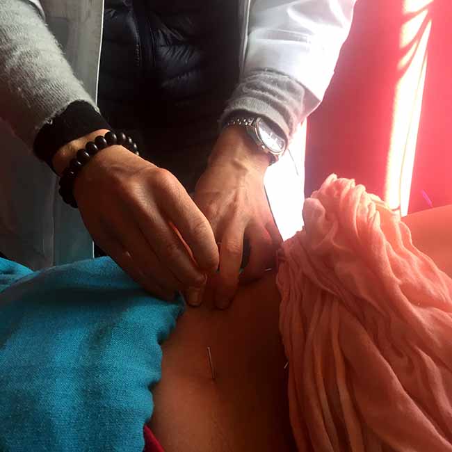 Acupuncture Relief Project  | Good Health Nepal | Sugandhi Jordan